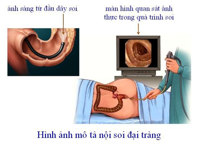 Muốn phát hiện sớm ung thư đường tiêu hóa, cần làm các xét nghiệm gì? - 4 Muốn phát hiện sớm ung thư đường tiêu hóa, cần làm các xét nghiệm gì? - 4