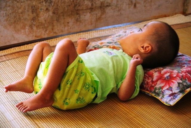 Xót xa bé gái 3 tuổi mắc bệnh não úng thủy nằm chờ chết ở nhà tình thương - 3 Đã hơn 3 tuổi, nhưng Mai Chi chỉ nặng vỏn vẹn hơn 6kg
