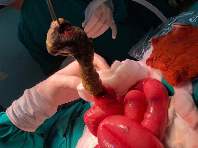 Mắc hội chứng “công chúa tóc mây” bé 6 tuổi tắc ruột - 1 Búi tóc lớn, đan vào nhau gây tắc ruột non của bệnh nhi