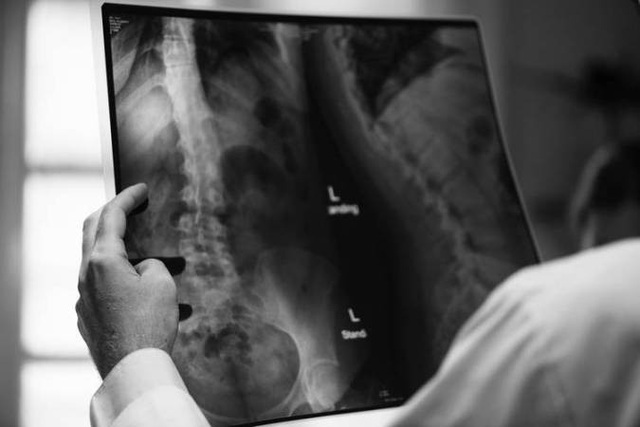 Bí ẩn hội chứng xương biến mất mà không rõ lý do - 1 Hội chứng kỳ lạ khiến xương trong cơ thể dần dần biến mất
