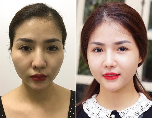 Thực hư về hạ gò má giúp trẻ ra chục tuổi - 2 Chị Thùy Dung (Hà Nội) trẻ hơn nhiều tuổi sau khi hạ gò má