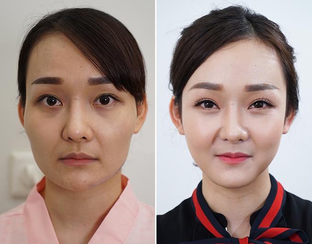 Thực hư về hạ gò má giúp trẻ ra chục tuổi - 3 Thực hư về hạ gò má giúp trẻ ra chục tuổi - 3
