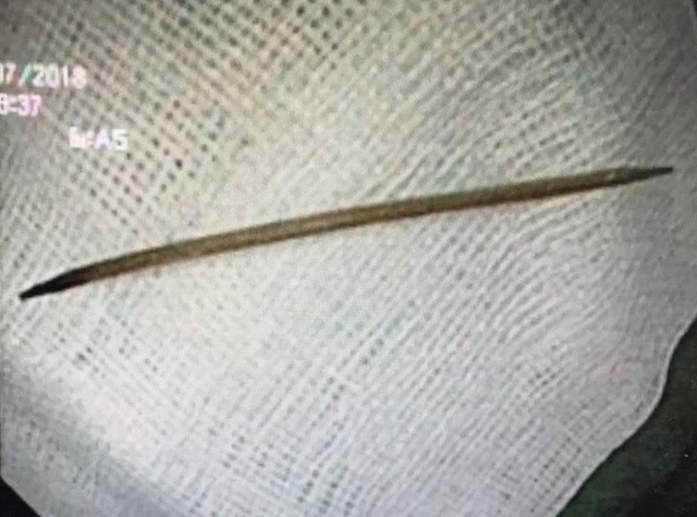Suýt thủng dạ dày vì nuốt tăm nhiều ngày không biết - 1 Cây tăm nhọn 2 đầu được lấy ra từ dạ dày của người bệnh