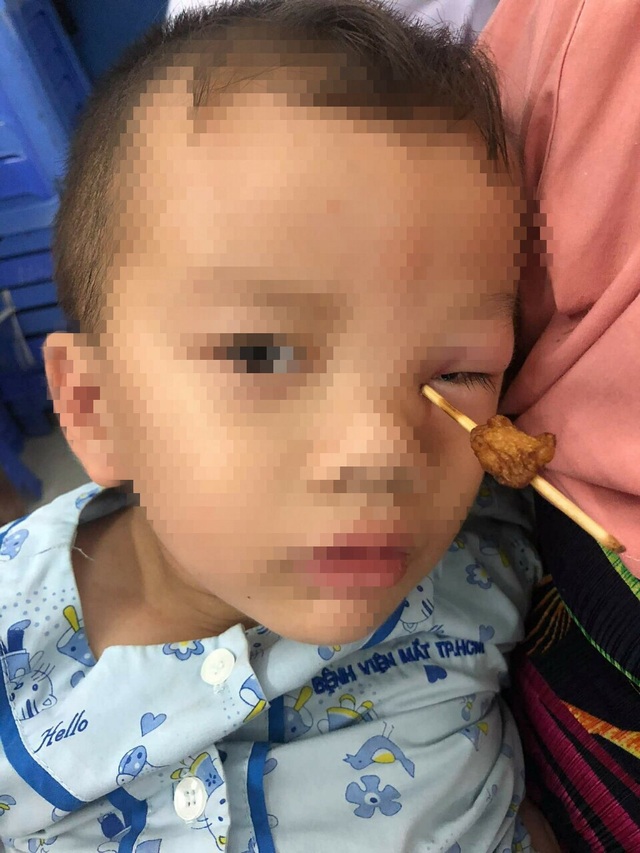 Bé 4 tuổi bị cây xiên thịt đâm thấu hốc mắt - 1 Cây xiên thịt viên chiên đâm thấu hốc mắt của bệnh nhi