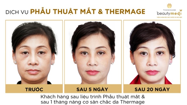 Thượng vàng hạ cám thị trường phẫu thuật thẩm mỹ Mắt ở Việt Nam - 3 Hình ảnh khách hàng trước và sau khi thực hiện phẫu thuật trẻ hóa đôi mắt tại Viện chăm sóc sức khỏe và sắc đẹp Thanh Hằng Beauty Medi