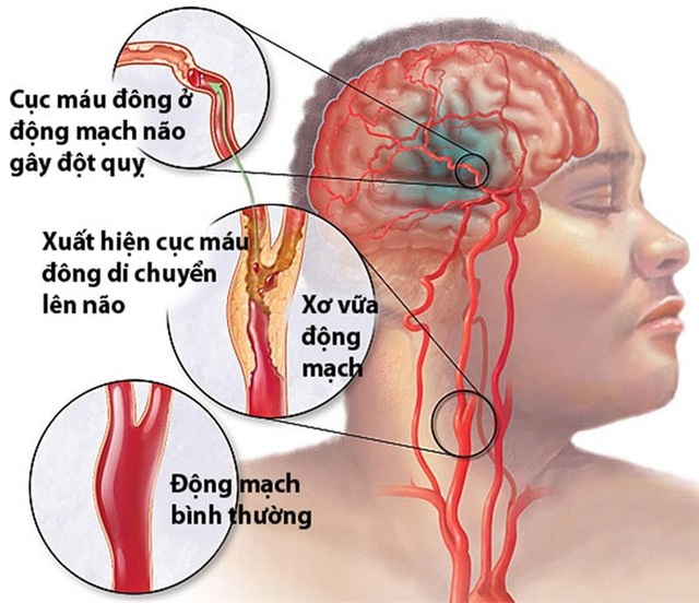 Khống chế tử thần đột quỵ bằng bí quyết 125 năm của người Nhật - 2 Nattokinase là một loại enzym sở hữu có khả năng phân hủy huyết khối mạnh nhất trong các dòng enzym