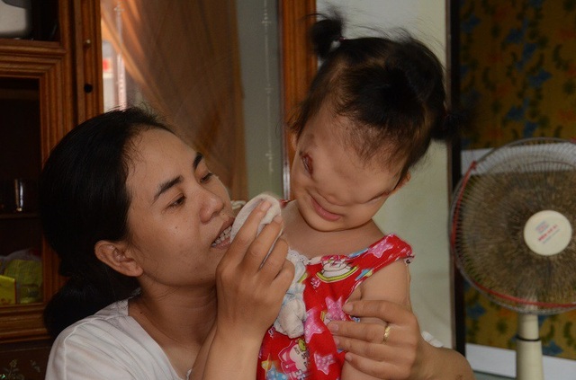 Xót xa trước số phận bất hạnh của cô bé 3 tuổi có khuôn mặt dị dạng - 5 Vợ chồng chị Linh vẫn luôn khao khát chữa trị cho đứa con bé bỏng, thế nhưng chi phí quá lớn