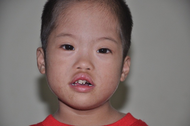 Không vay nổi 20 triệu đồng, tính mạng bé 3 tuổi nguy kịch vì bệnh tim - 2 Cậu bé 3 tuổi bị bệnh tim và bệnh down bẩm sinh.
