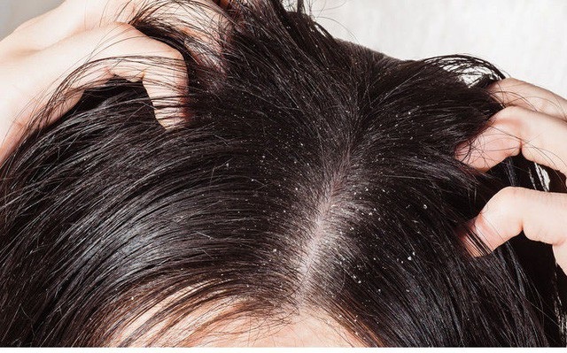 Hãi hùng những cách trị chấy bá đạo của người lớn cho trẻ