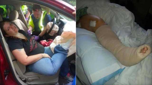 Vì sao không nên gác chân lên táp-lô? - 2
Audra Tatum đang được sơ cứu trong xe (trái) và chân phải bó bột khi tới bệnh viện sau đó (phải)