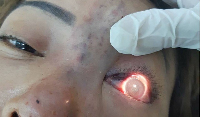 Vụ tiêm filler mù mắt: Cơ sở spa quảng cáo trên facebook để câu khách - 1 Nạn nhân của tiêm filler làm đầy sống mũi bị mù mắt