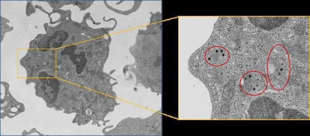 Virus có triển vọng mới trong điều trị ung thư - 1
Hình ảnh từ kính hiển vi điện tử cho thấy các tế bào bạch cầu chứa các hạt virus (được thể hiện trong các vòng tròn màu đỏ).