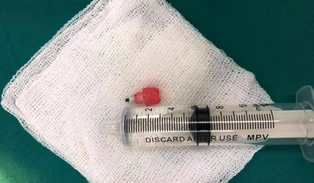 Bé 6 tuổi ngưng tim, ngưng thở vì bị hóc mẩu bút chì - 2 Đầu bút chì dài 2cm được gắp ra từ phế quản của bệnh nhân.