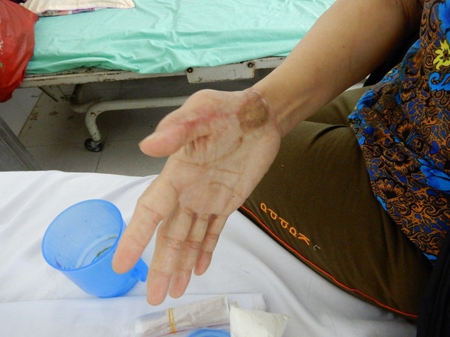 Thắt nghẹn trước hoàn cảnh của người đàn bà bị máy dán gỗ cuốn dập nát tay - 4 Và lòng bàn tay sau tai nạn lao động