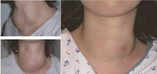 Nhân thùy trái tuyến giáp tirads 3 có nguy hiểm không? - 2 Nhân thùy trái tuyến giáp tirads 3 có nguy hiểm không? - 2