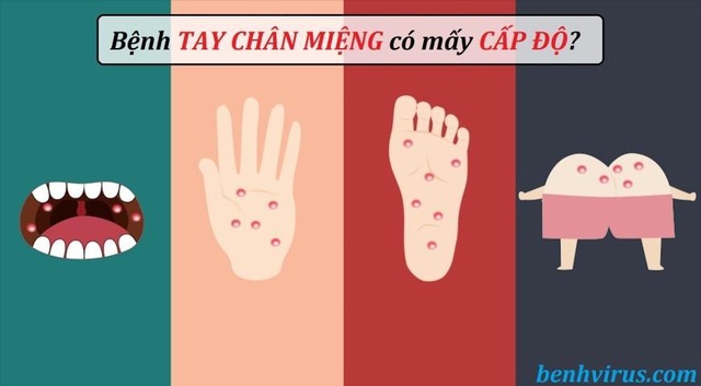 Bệnh tay chân miệng có mấy cấp độ? Cách điều trị như thế nào? - 2 Bệnh tay chân miệng có mấy cấp độ? Cách điều trị như thế nào? - 2