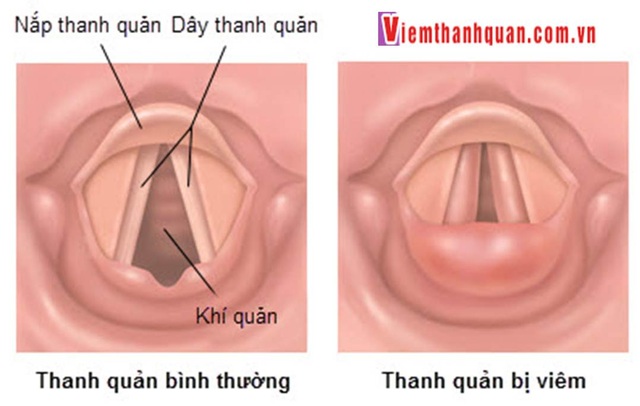 4 mẹo dân gian chữa khản tiếng dễ dàng! | Báo Dân trí