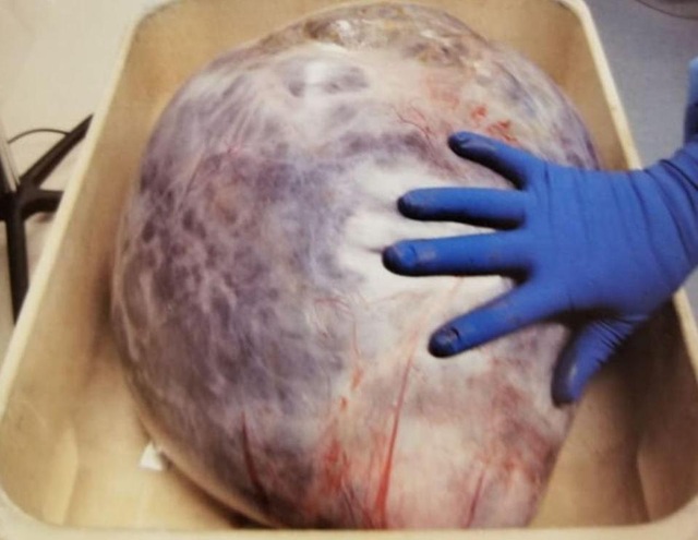 Choáng váng với khối u 22 kg lấy ra từ cơ thể bệnh nhân lạc nội mạc tử cung - Ảnh minh hoạ 3