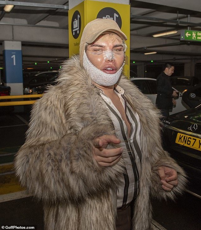 Búp bê Ken Rodrigo Alves lộ mặt sưng phồng sau ca dao kéo - 3 Búp bê Ken Rodrigo Alves lộ mặt sưng phồng sau ca dao kéo - 3