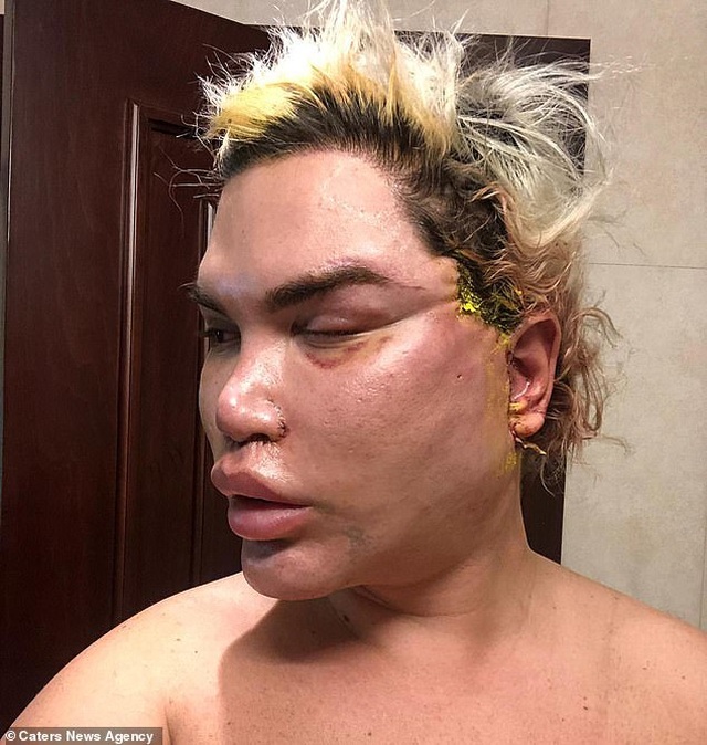 Búp bê Ken Rodrigo Alves lộ mặt sưng phồng sau ca dao kéo - 7 Búp bê Ken Rodrigo Alves lộ mặt sưng phồng sau ca dao kéo - 7