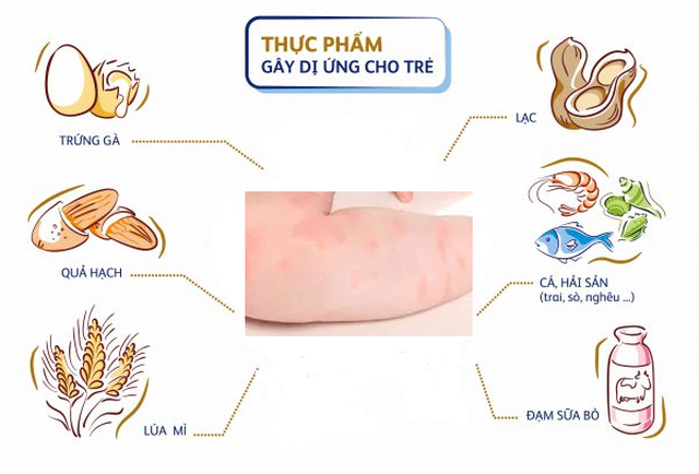 Các loại thực phẩm có thể gây dị ứng ở trẻ.