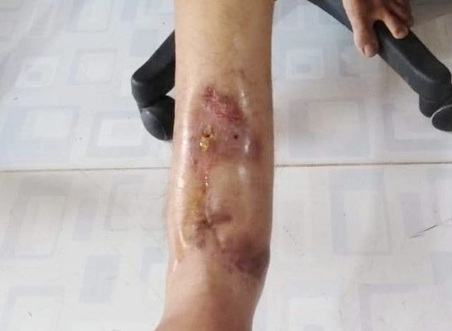Xương chân phải bị mục chỉ còn mạch máu, nam thanh niên cần phẫu thuật cấp - 3 Xương chân phải bị mục chỉ còn mạch máu, nam thanh niên cần phẫu thuật cấp - 3