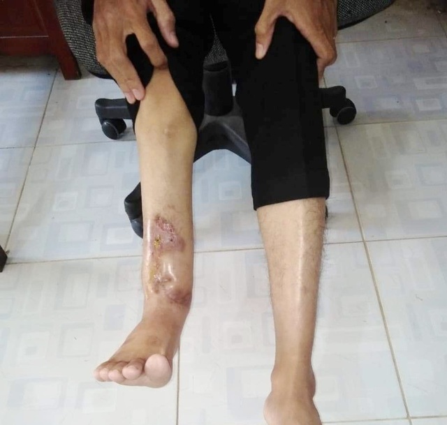 Xương chân phải bị mục chỉ còn mạch máu, nam thanh niên cần phẫu thuật cấp - 2 Xương chân phải bị mục chỉ còn mạch máu, nam thanh niên cần phẫu thuật cấp - 2