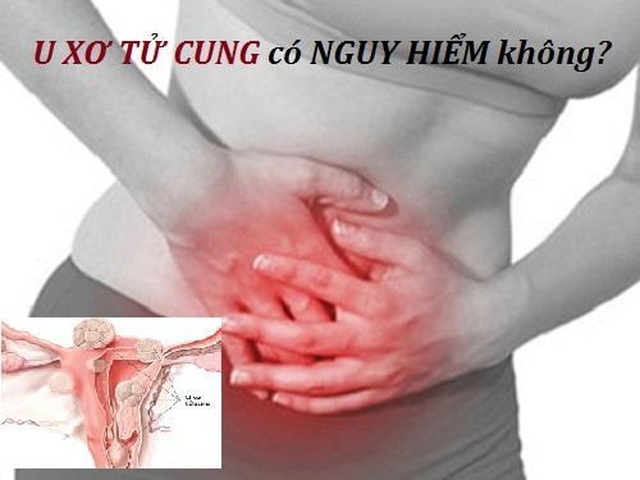 Biến chứng u xơ tử cung có nguy hiểm không? - 1 Biến chứng u xơ tử cung có nguy hiểm không? - 1