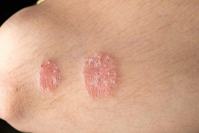 Bệnh vảy nến có di truyền không? - 1 Bệnh vảy nến có di truyền không? - 1