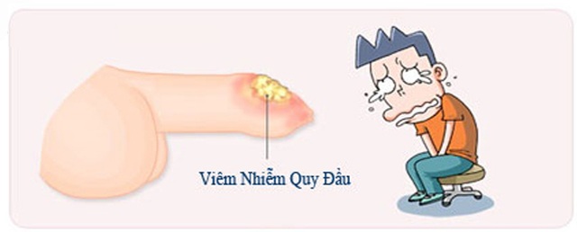 Bao quy đầu dài có nguy hiểm không? - 2