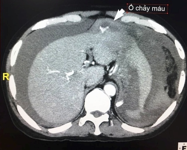 Đau bụng dữ dội sau ngã, phát hiện u gan bị vỡ  - 1
