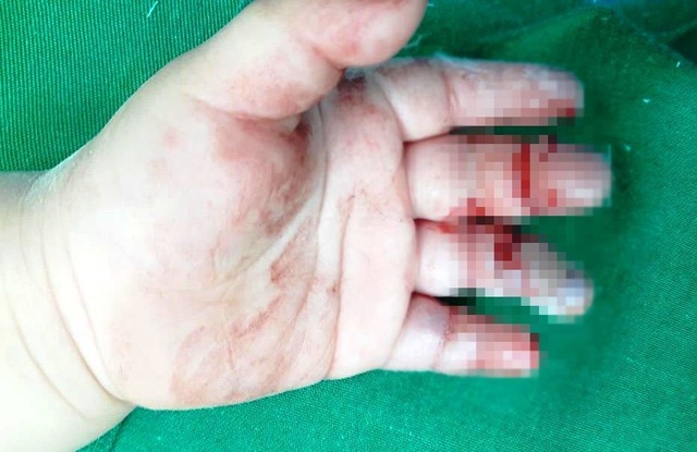Các ngón bàn tay trái của cháu T.A bị dập nát do bị cuốn bàn tay vào máy xay thịt. Các ngón bàn tay trái của cháu T.A bị dập nát do bị cuốn bàn tay vào máy xay thịt.
