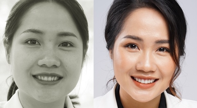 Răng sứ thẩm mỹ có phải chỉ để… thẩm mỹ? - 2 Răng sứ thẩm mỹ có phải chỉ để… thẩm mỹ? - 2
