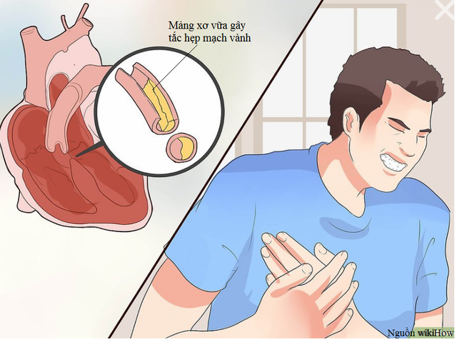Triệu chứng bệnh mạch vành không phải lúc nào cũng bắt đầu bằng cơn đau thắt ngực - 2 Triệu chứng bệnh mạch vành không phải lúc nào cũng bắt đầu bằng cơn đau thắt ngực - 2