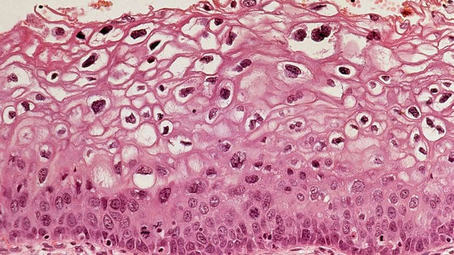 Vắc-xin HPV giúp giảm đáng kể nguy cơ ung thư cổ tử cung - 1 Vắc-xin HPV giúp giảm đáng kể nguy cơ ung thư cổ tử cung - 1