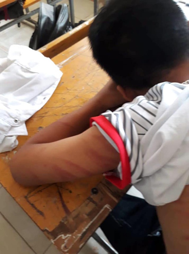 Học sinh lớp 8 đến lớp với nhiều vết thương, nghi bị bố đánh dã man - 2 Học sinh lớp 8 đến lớp với nhiều vết thương, nghi bị bố đánh dã man - 2