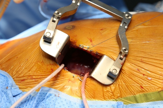 Ca mổ tim ít xâm lấn đầu tiên tại bệnh viện tuyến quận - 1 Ca mổ tim ít xâm lấn đầu tiên tại bệnh viện tuyến quận - 1