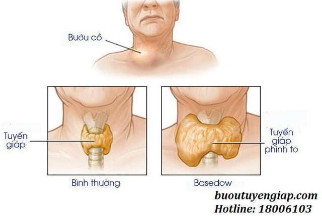 Triệu chứng của bệnh bướu cổ Basedow là gì? | Báo Dân trí