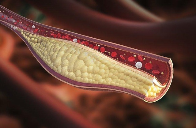 Điều trị rối loạn lipid máu như thế nào? - 2 Điều trị rối loạn lipid máu như thế nào? - 2