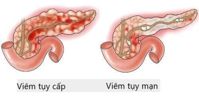 Điều trị rối loạn lipid máu như thế nào? - 3 Điều trị rối loạn lipid máu như thế nào? - 3