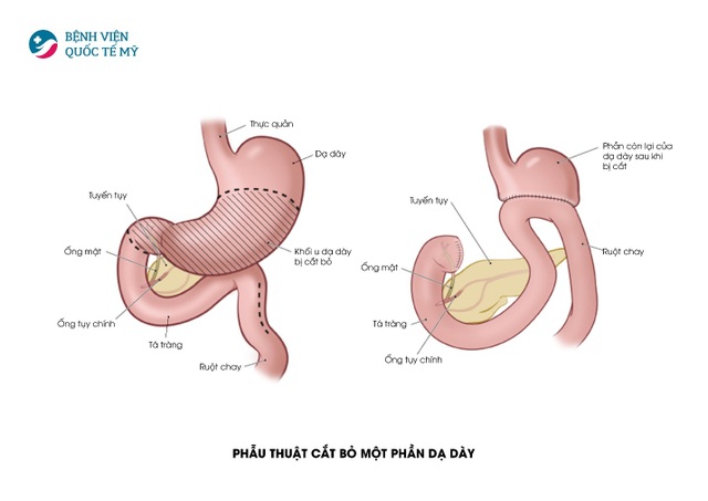 Điều trị ung thư dạ dày bằng phương pháp phẫu trị tiêu chuẩn Mỹ - 1 Điều trị ung thư dạ dày bằng phương pháp phẫu trị tiêu chuẩn Mỹ - 1