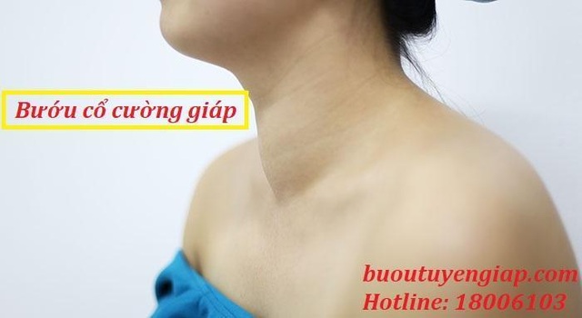 Bướu cổ cường giáp và tất cả những điều bạn cần biết - 1 Bướu cổ cường giáp và tất cả những điều bạn cần biết - 1