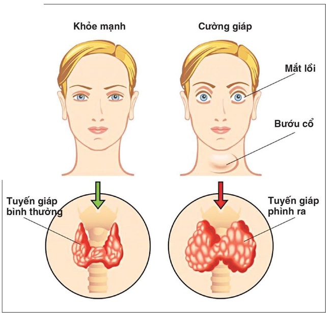 Làm thế nào để phòng ngừa bệnh bướu cổ cường giáp?