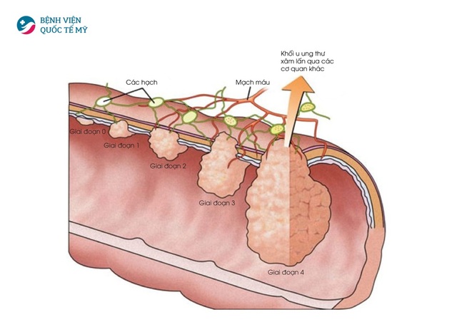 Phương pháp điều trị ung thư trực tràng - 1 Phương pháp điều trị ung thư trực tràng - 1