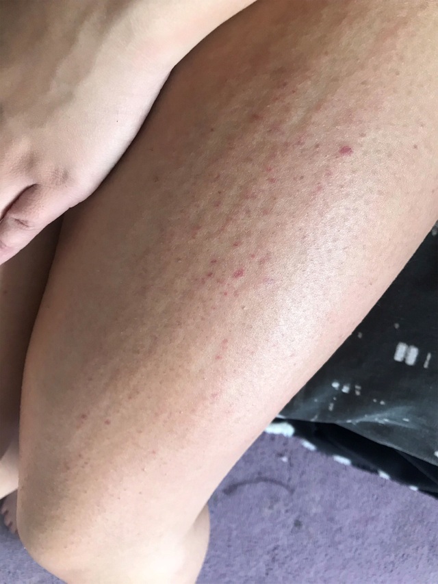 Cô gái mắc bệnh cực hiếm dị ứng... nước: Chỉ đổ mồ hôi cũng gây đau đớn - 2 Cô gái mắc bệnh cực hiếm dị ứng... nước: Chỉ đổ mồ hôi cũng gây đau đớn - 2