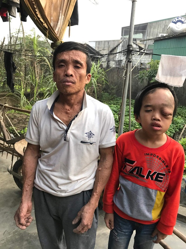 Người cựu binh tuyến lửa không sợ bom đạn hằng đêm nằm ôm con khóc - 3 Người cựu binh tuyến lửa không sợ bom đạn hằng đêm nằm ôm con khóc - 3