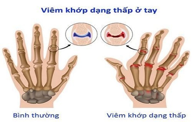 3 cách phòng ngừa bệnh Viêm khớp dạng thấp - 1 3 cách phòng ngừa bệnh Viêm khớp dạng thấp - 1