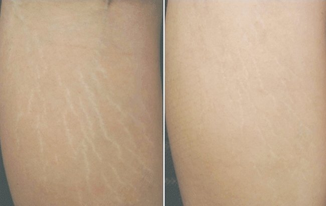 #4 cách trị rạn da đỏ tại nhà, cần gì phải đến viện thẩm mỹ