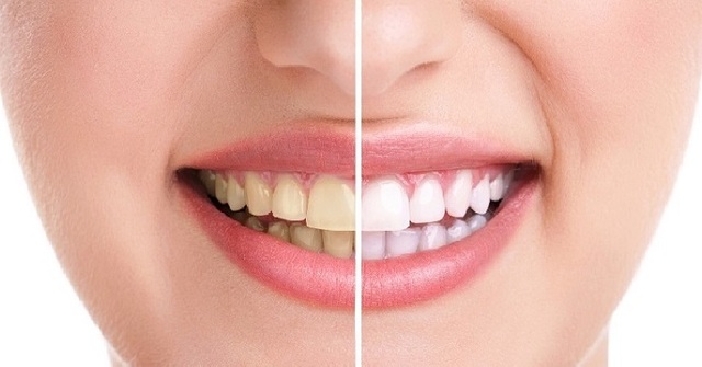 Những thói quen gây hại cho răng - 2 Những thói quen gây hại cho răng - 2