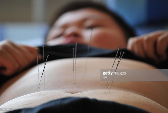 Châm cứu điều trị được những bệnh gì? - 1 Châm cứu điều trị được những bệnh gì? - 1